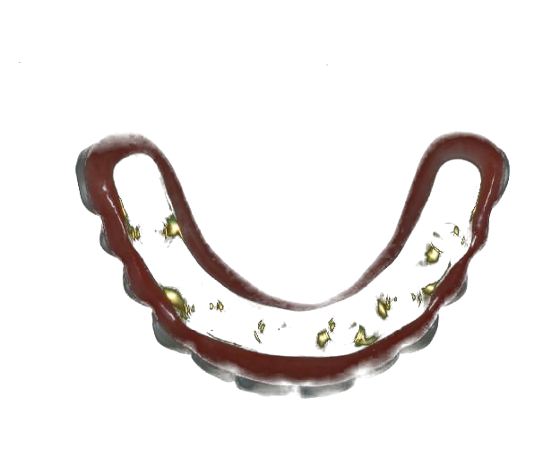 Crown and bridge restoration