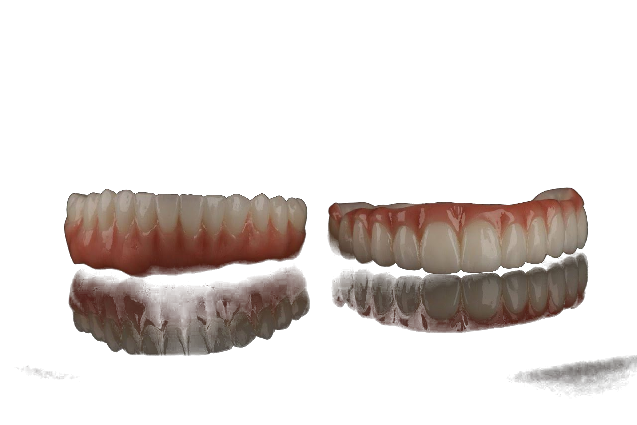 Layered zirconia prosthesis